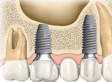 30岁满口牙全坏了能种植吗?种植体系有哪些组成?