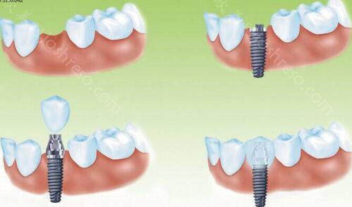 种植牙详细步骤图解，种植牙能一次性做吗？