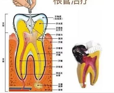 根管治疗步骤图解，根管治疗一般分几步？