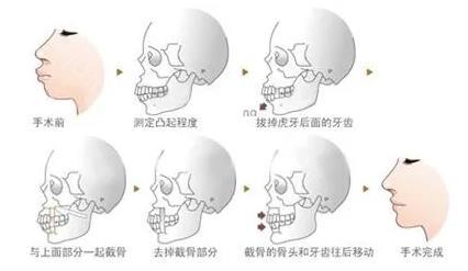 正颌骨手术千万别去做？为什么有人说做正颌手术不能做？