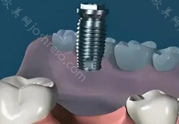 种植牙牙科诊所收费价目表，2024做种植牙费用你知道吗？