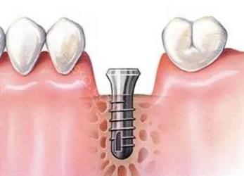 种植牙牙科诊所收费价目表，2024做种植牙费用你知道吗？