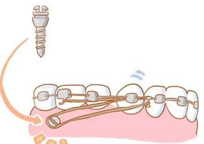 整牙打骨钉和不打骨钉的区别有哪些？整牙齿打骨钉安全吗？