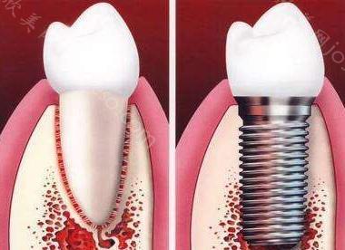 北京种植牙多少钱一颗？种植牙国产和进口哪个好？