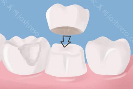 北京做牙冠多少钱一颗？牙冠的材质和费用解析！