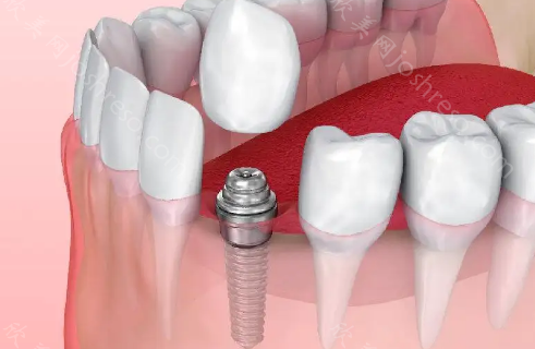 深圳口腔医院种植牙多少钱？可以走医保吗？