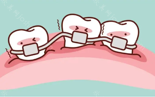 矫正牙齿拔牙齿有什么影响?厦门登特罗艳平医生不会骗我吧?