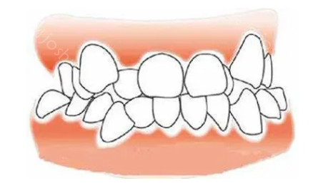 矫正牙齿拔牙齿有什么影响?厦门登特罗艳平医生不会骗我吧?