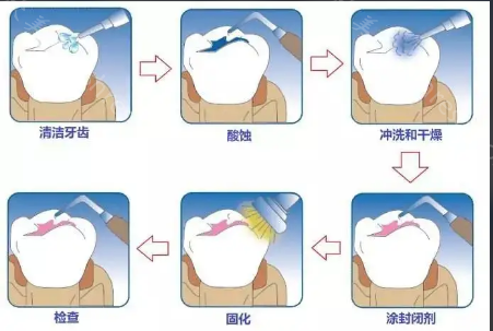 上海仁博口腔科普-牙周护理是预防牙周炎的重要途经！