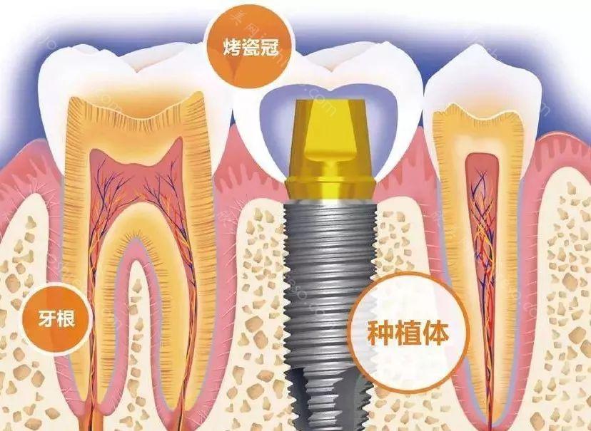 瑞典诺贝尔种植牙 精湛快捷美牙效果先知先觉