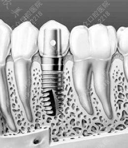 种植牙 让您告别无齿之途