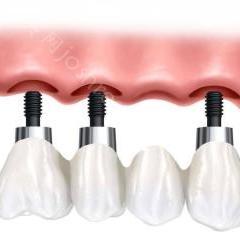 种植牙到底是怎么样的技术呢