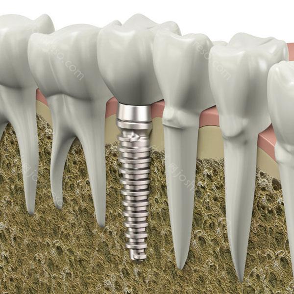 上海做种植牙的利与弊是什么