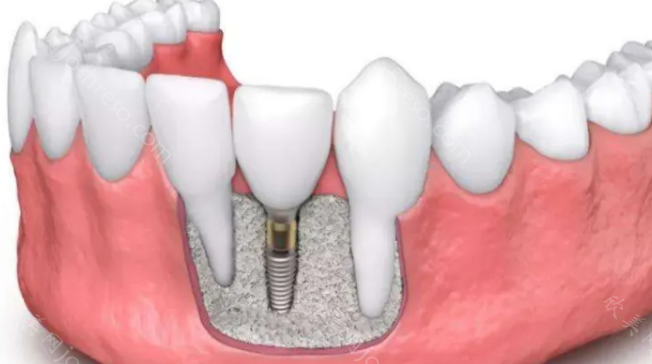 美奥口腔医院种植牙价格贵吗?具体情况给大家收集好了