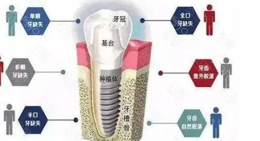 福建医科大学附属口腔医院收费价目表，种植牙价格一目了然