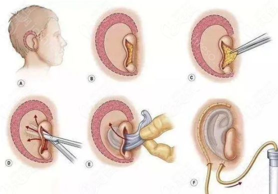全国排名较好的耳朵整形医院，这几家值得收藏，价格不贵