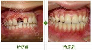 成年人门牙掉了要怎么办 种植牙来修复