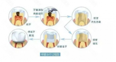 根管的治疗具体步骤是什么?根管治疗一颗牙多少钱?