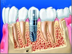种植牙的生命路程有多远