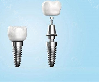 国产种植牙价格表公布：含各国的种植体价格表参考