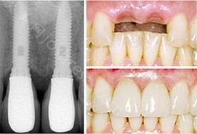 医生为您讲解：种植牙修复具有哪些优势
