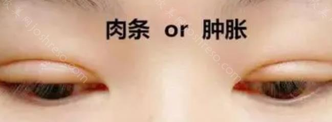 双眼皮肉条和肿的区别图片，双眼皮肉条发生后怎么办才好？