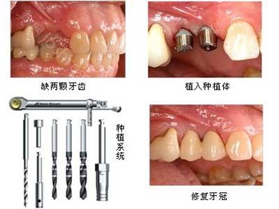 种植牙的步骤是什么