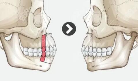 牙凸和骨凸的区别图片，一文带你了解齿性嘴凸和骨性嘴凸的区别！