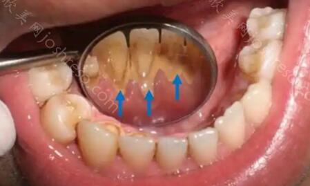 不要随便做龈下刮治？什么样的情况适合做龈下刮治？
