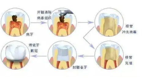 后悔做了牙齿打桩做冠，终于明白为啥有的人后悔做了