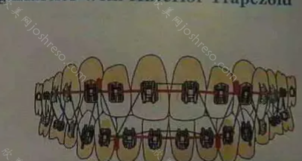 隐形牙套挂皮筋的作用大吗?参考各类牵引钉挂法示意图