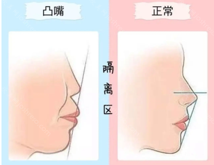 假凸嘴和真凸嘴的区别：正确鉴定自己的嘴凸不凸