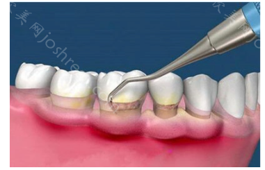 龈下刮治好处和坏处，多少钱?