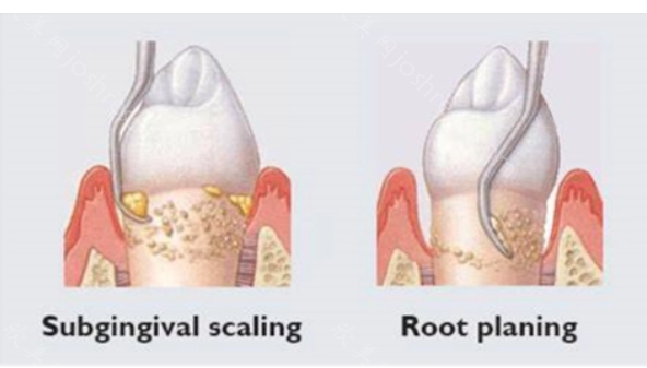 龈下刮治好处和坏处，多少钱?