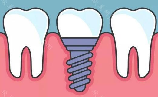 北京京皓口腔种植牙价格？国产，进口价格差异大！