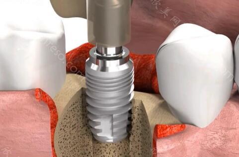 北京京皓口腔种植牙价格？国产，进口价格差异大！