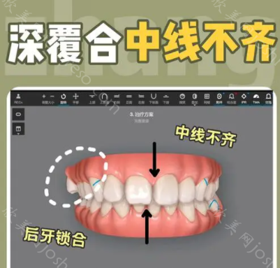 8种牙齿正畸动态图，正面解析矫正全过程图