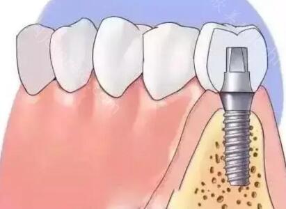 西安伟康口腔种植牙收费贵吗？国产、韩、美、德、法进口价格都不同！
