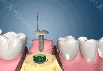 丰台口腔门诊部种植牙收费贵吗？种植牙价格选项多有高也有低！