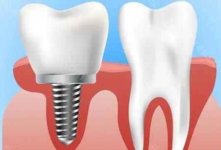 朝天门医院口腔种植牙价格多少？种植牙3500-23000元都有！