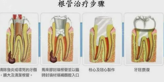 牙齿根管治疗价格是多少?哪些因素会影响收费?