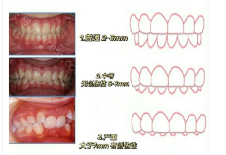 牙齿深覆合和深覆盖的区别，附两者矫正变化图