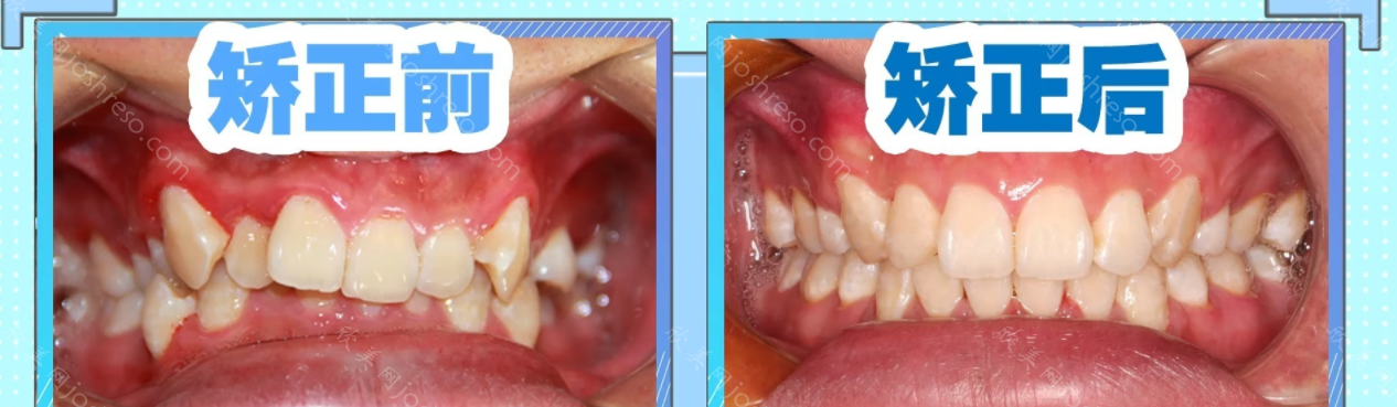 牙齿深覆合和深覆盖的区别，附两者矫正变化图