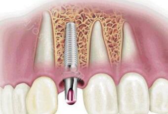 重庆种植牙医院哪家能做？重庆种植牙多少钱一颗？