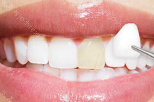珠海美白牙齿多少钱？珠海网友分享本地不错的牙齿美白医院！