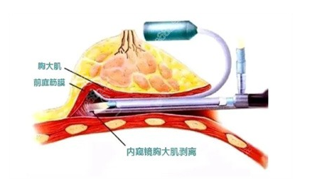 武汉仁爱时光隆胸效果好不好?包涛医生隆胸技术特点分享