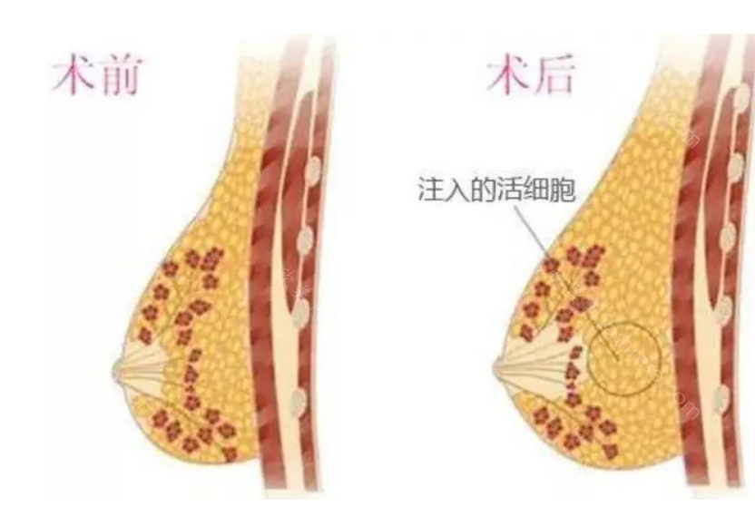 武汉仁爱时光隆胸效果好不好?包涛医生隆胸技术特点分享