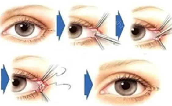 适合开外眼角的眼型有哪些?开外眼角费用,手术注意事项!