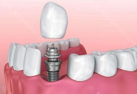 种植牙材质分3种吗?种植牙组成部分解析!