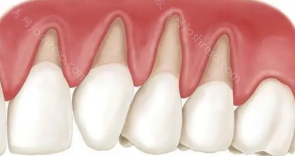 40岁牙龈萎缩牙根都出来了怎么办?